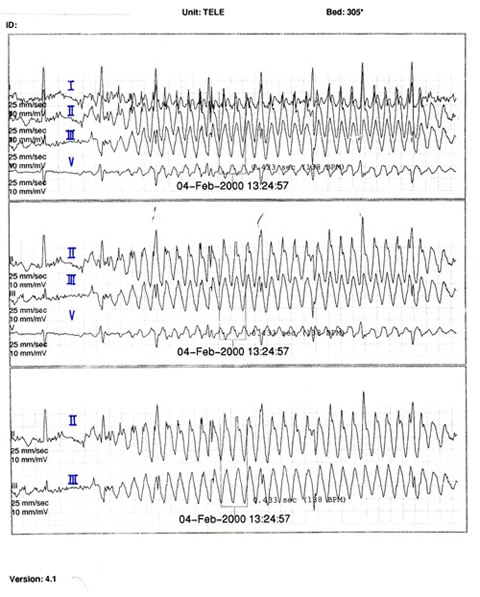 Wpw Rhythm