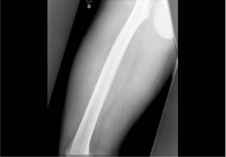  soft tissue calcification consistent with myositis ossificans.