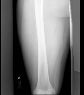 Myositis ossificans is a benign heterotopic ossification of soft tissue 