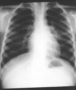 tuberculosis x ray. old boy with tuberculosis