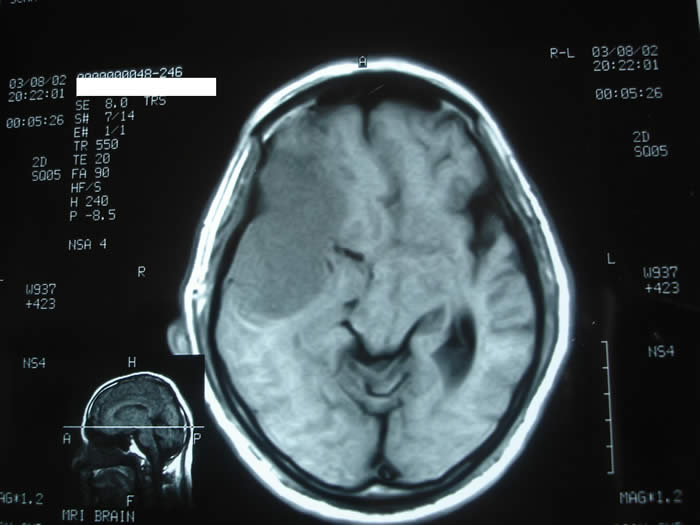 mri brain scan. MRI brain