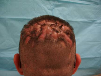 scalp infection pictures