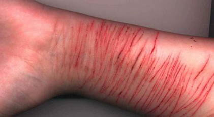 deep self harm cuts on arm